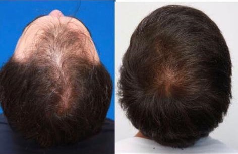 Trapianto dei capelli a Istanbul, capitale mondiale del capello